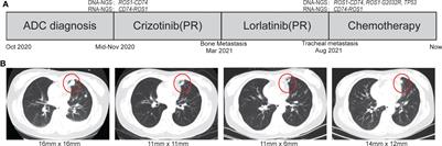 Case report: A novel reciprocal ROS1-CD74 fusion in a NSCLC patient partially benefited from sequential tyrosine kinase inhibitors treatment